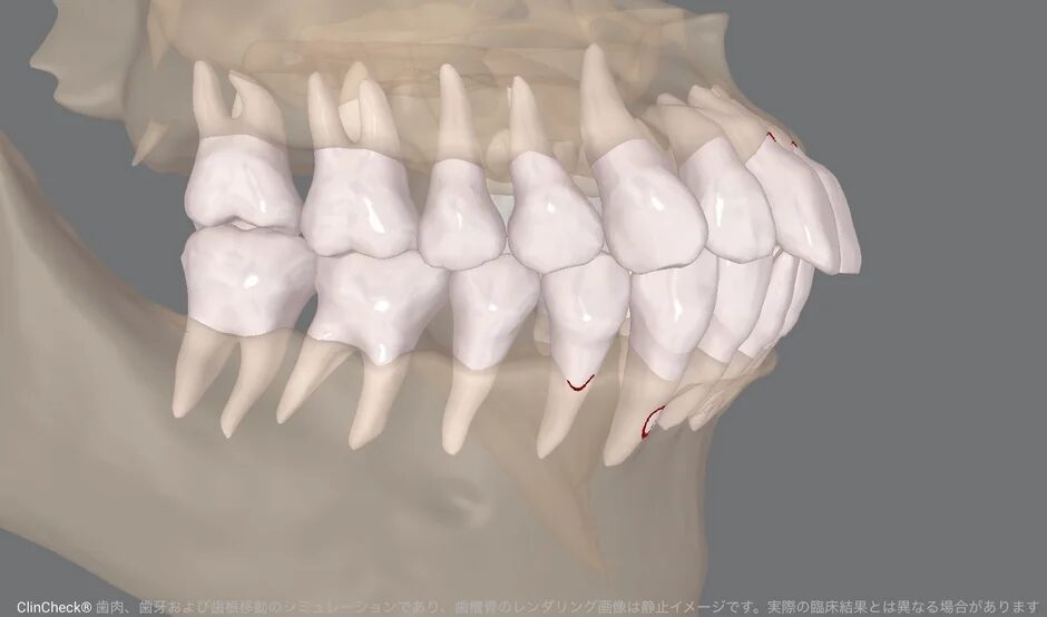 歯肉、歯牙および歯根移動のシミュレーション