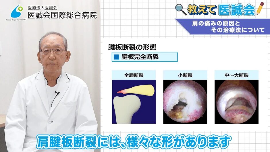 肩腱板断裂の形態を解説する図