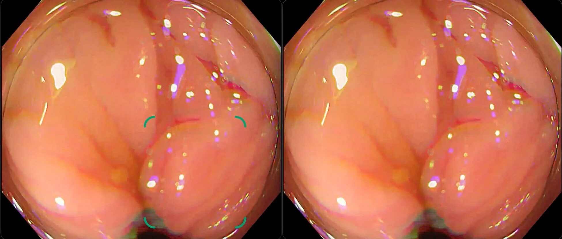 ひだによる偽陽性改善の例