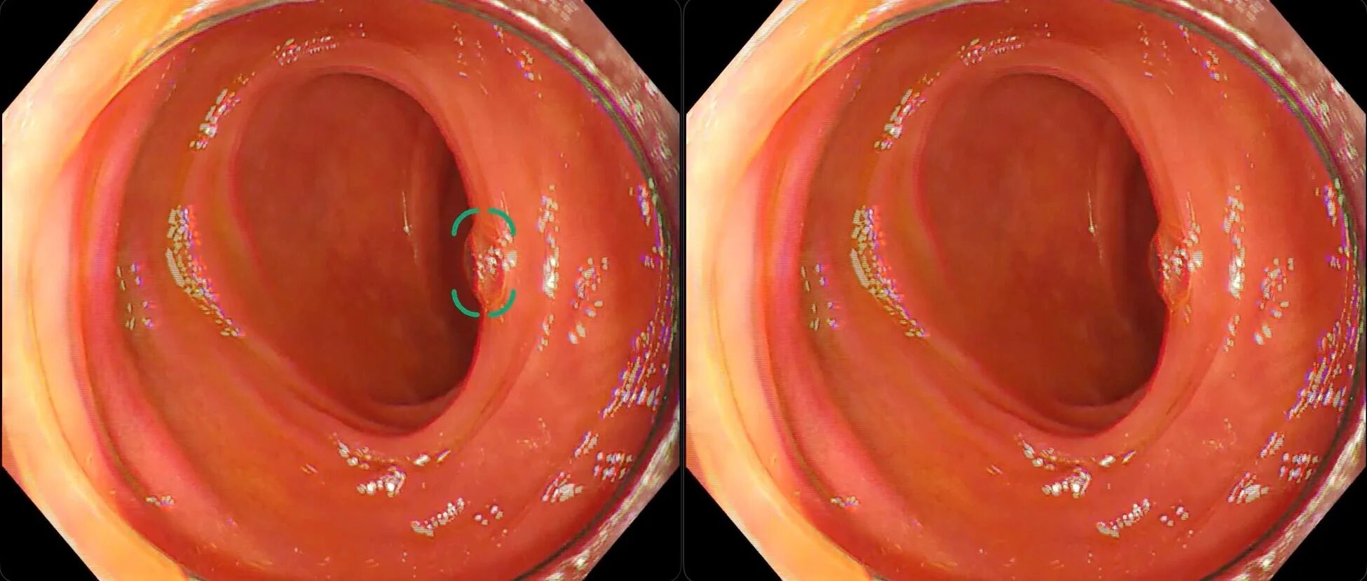 泡による偽陽性改善の例