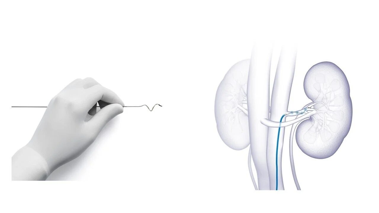 Symplicity Spyral腎デナベーションシステム