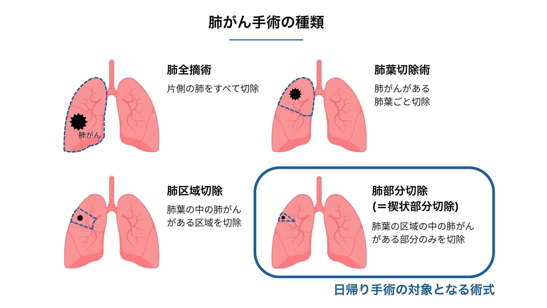 肺がん手術の種類