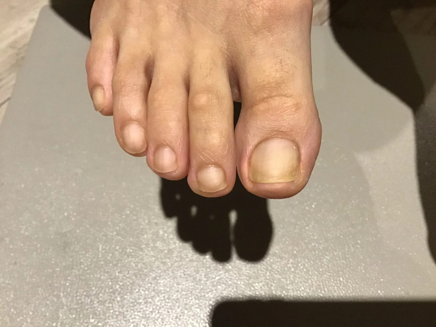 爪のトラブル改善例