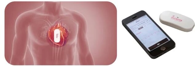 心臓に装着されたウェアラブルセンサーとスマートフォン、durantaのデバイス