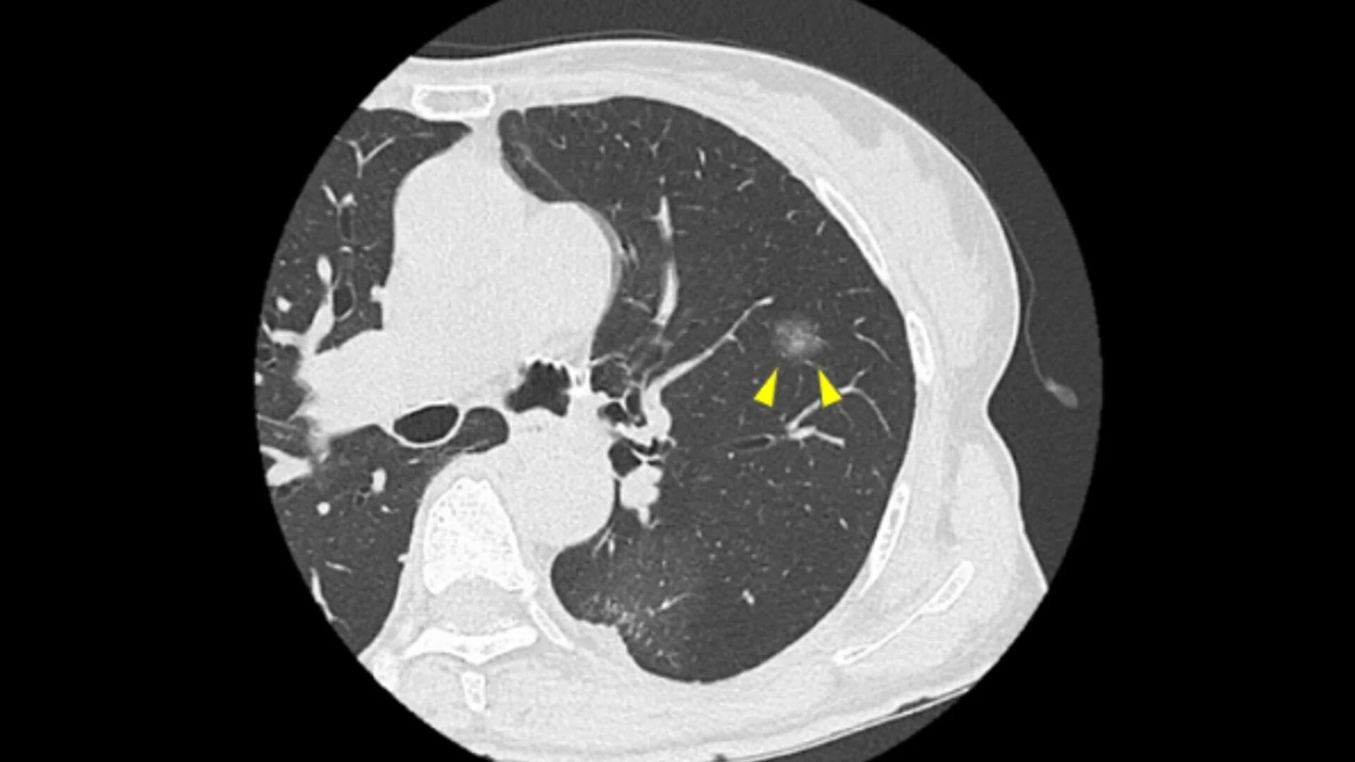 胸部CTスキャン画像