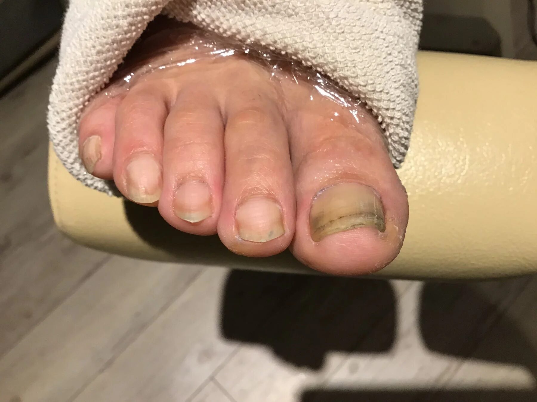 爪のトラブル例