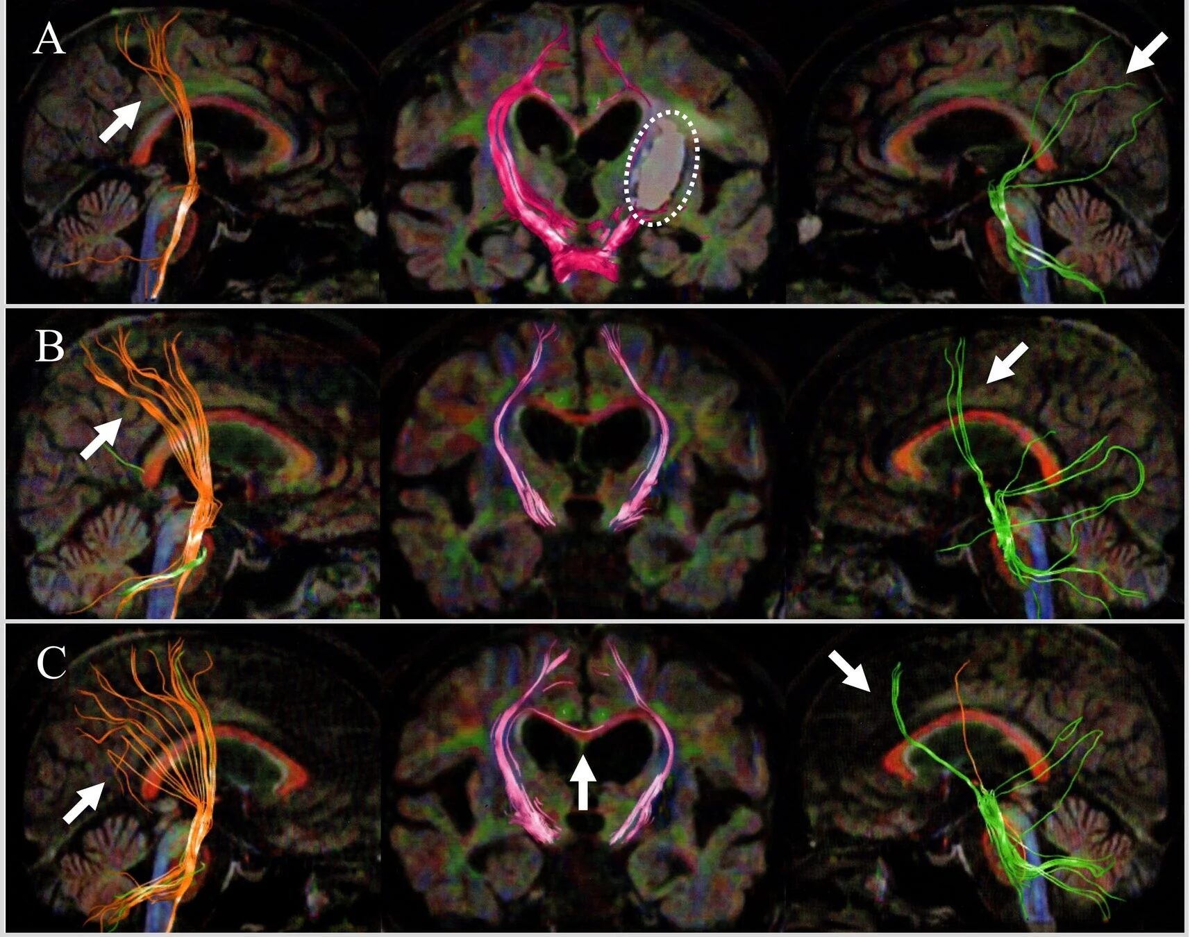 脳の拡散テンソル画像