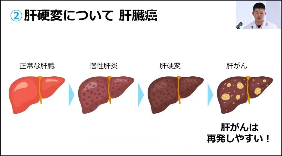 正常な肝臓から慢性肝炎、肝硬変、そして肝がんへと病状が進行する様子を段階的に示す医療教育スライド