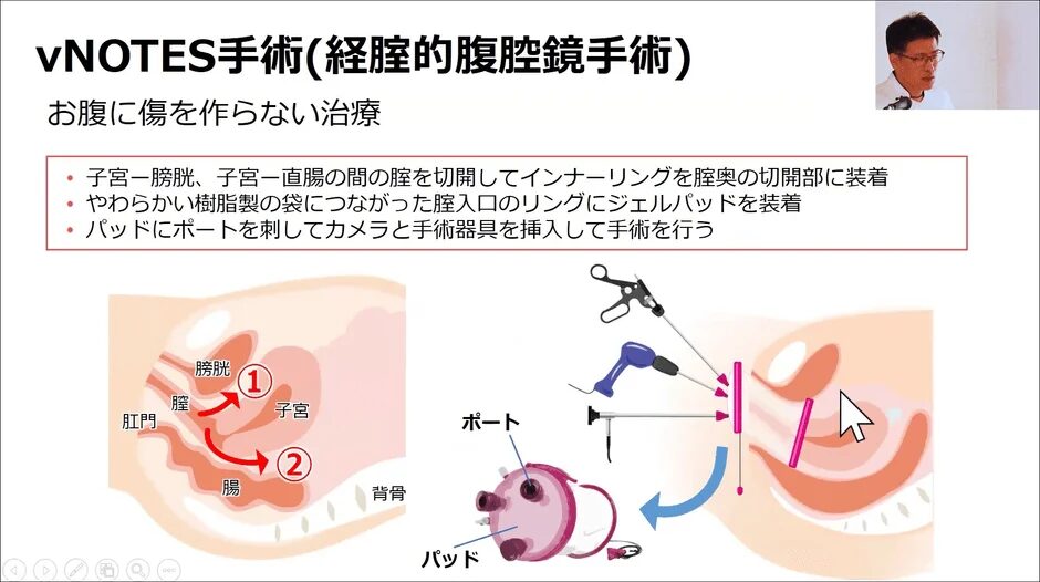 vNOTES手術の概要