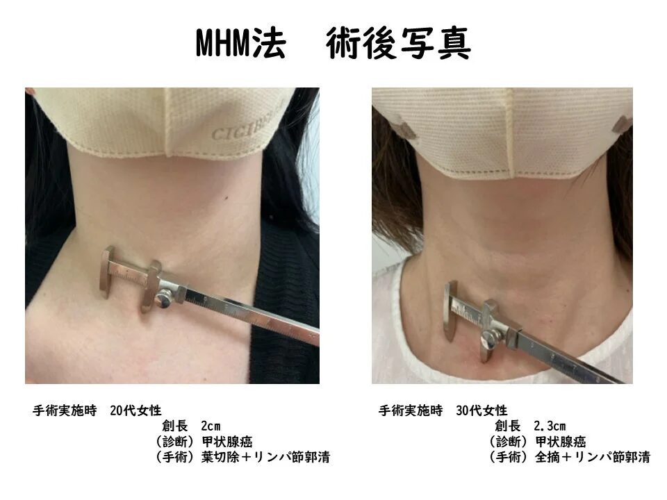 MHM法による甲状腺癌の術後写真