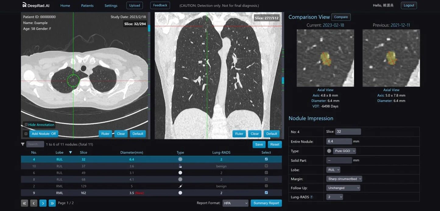 DeepLung-CACの診断支援システム画面