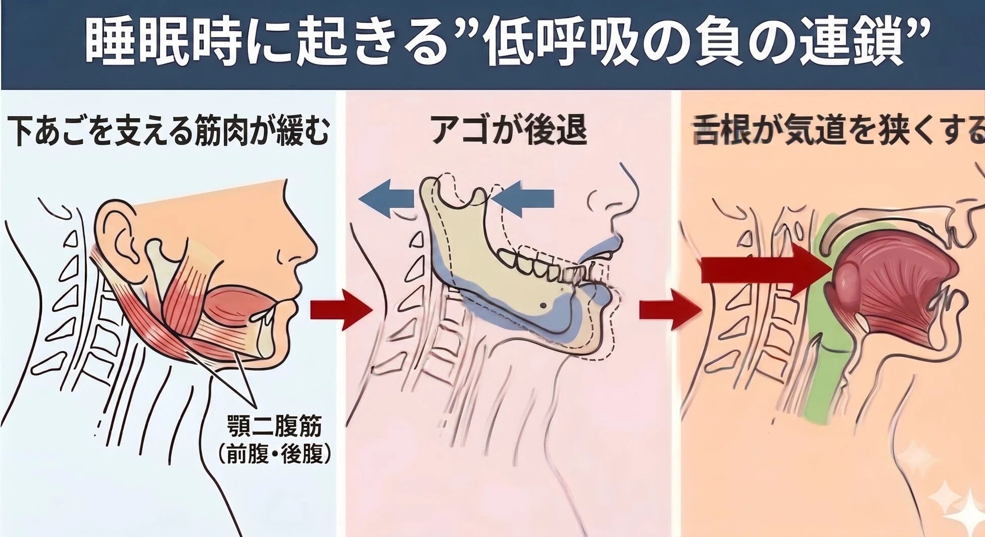 睡眠時に起きる低呼吸の負の連鎖